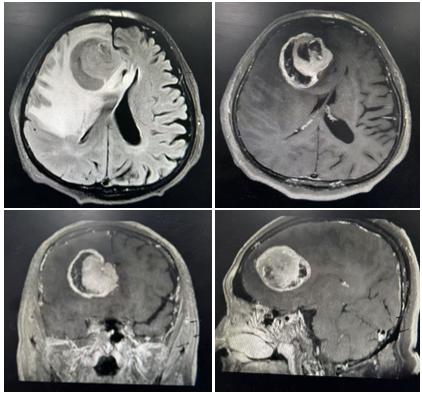 92 岁超高龄患者颅内藏巨大肿瘤致偏瘫!武大人民医院多学科协作成功「除瘤」
