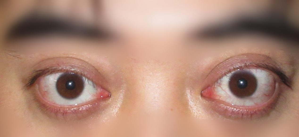 聚焦「眼凸」难题，爱尔眼科四川眼科医院首批入选这一全国性联盟！