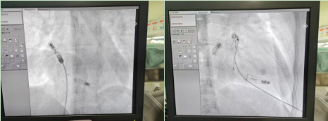 南昌大学二附院成功完成江西首例新一代 AVEIR™ DR 双腔植入式无导线心脏起搏器植入术