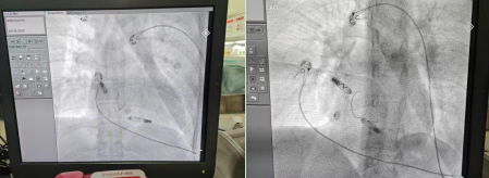 南昌大学二附院成功完成江西首例新一代 AVEIR™ DR 双腔植入式无导线心脏起搏器植入术