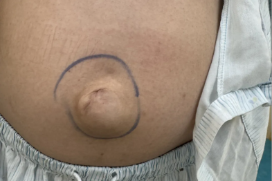 多学科协作！深圳市妇幼保健院成功治疗巨大子宫肌瘤合并脐疝患者