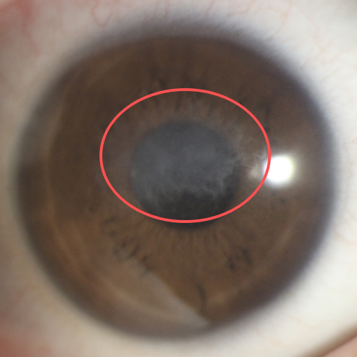 屈光术后防晒不到位，角膜长「雾霾」？军训烈日下更需严防！