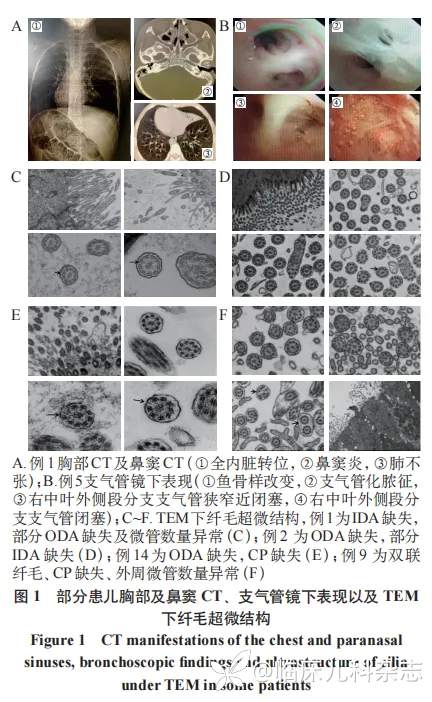 14 例原发性纤毛运动障碍临床表现、纤毛结构及基因特点分析