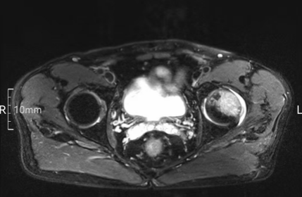 股骨头坏死,只能换关节?一附院骨科专家说:不一定!50 岁患者的保髋经历值得一看