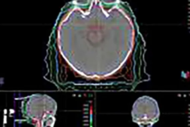 河北一洲肿瘤医院成功完成罕见儿童脑瘤治疗，成果论文登上国际知名期刊