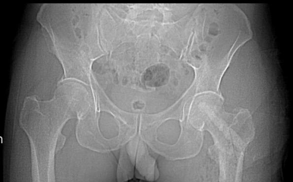 股骨头坏死,只能换关节?一附院骨科专家说:不一定!50 岁患者的保髋经历值得一看