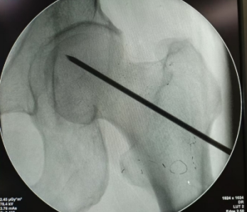 股骨头坏死,只能换关节?一附院骨科专家说:不一定!50 岁患者的保髋经历值得一看