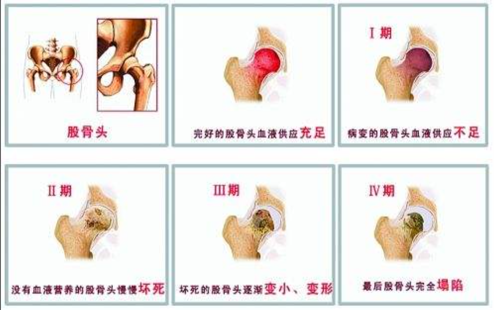 股骨头坏死,只能换关节?一附院骨科专家说:不一定!50 岁患者的保髋经历值得一看