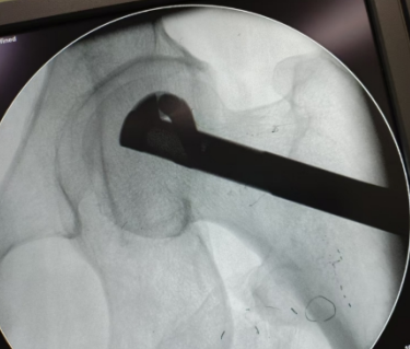 股骨头坏死,只能换关节?一附院骨科专家说:不一定!50 岁患者的保髋经历值得一看