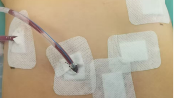 达芬奇机器人助力精准肝切除