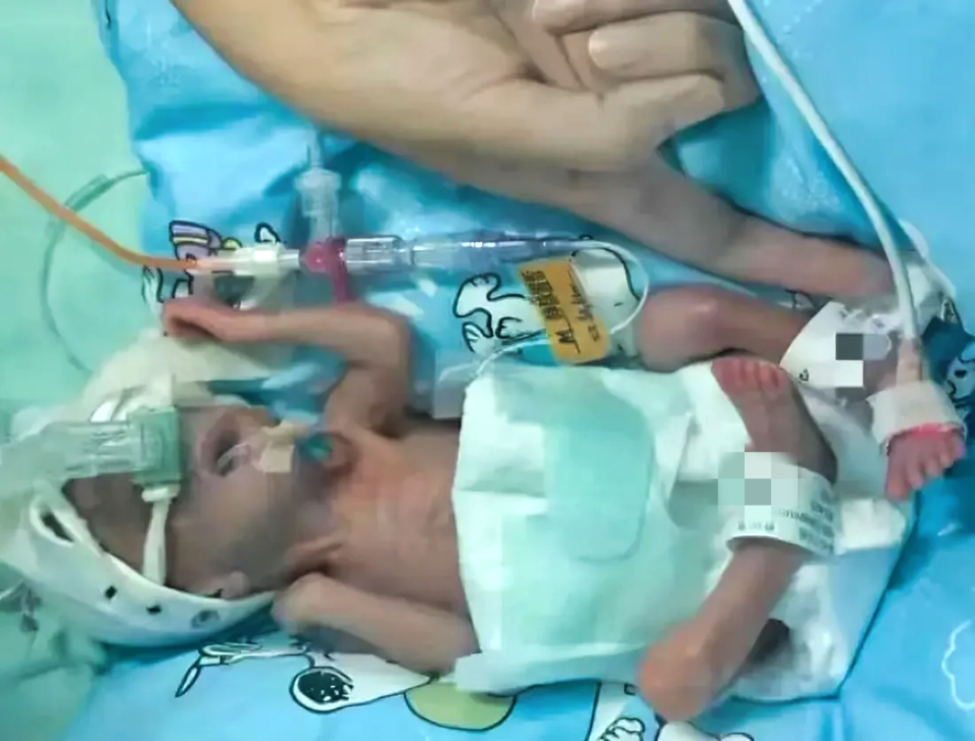 26 周、不足 2 斤!他们还有未来吗?