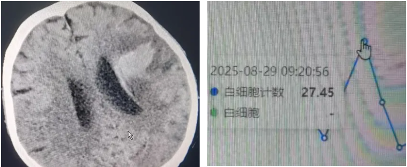 九死一生！桂林医科大学一附院中西医协同诊疗，为脑梗重症患者筑起生命防线