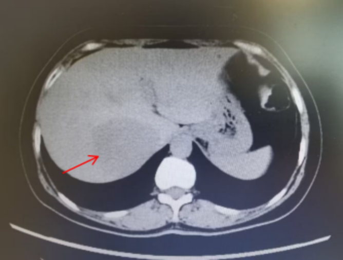 达芬奇机器人助力精准肝切除