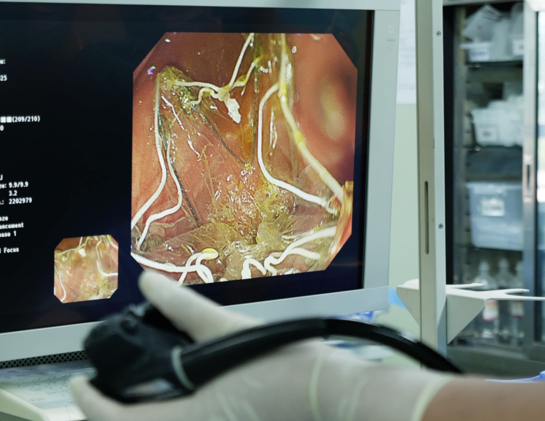 多学科联手「攻坚」极重度肥胖,嘉定区中心医院微创减重术获成功