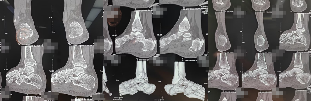 【融和有绝活】跟骨骨折不用「大动刀」,微创技术解您忧