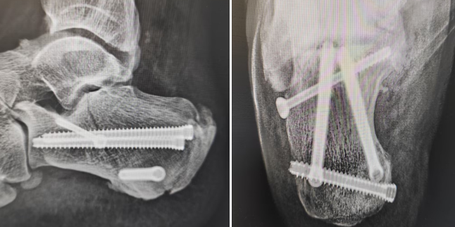 【融和有绝活】跟骨骨折不用「大动刀」,微创技术解您忧