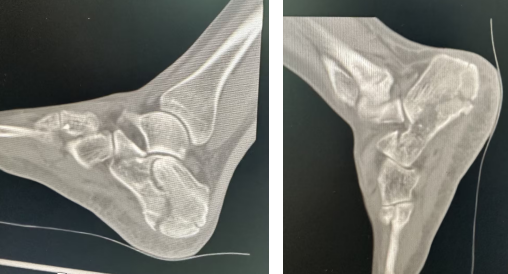 【融和有绝活】跟骨骨折不用「大动刀」,微创技术解您忧