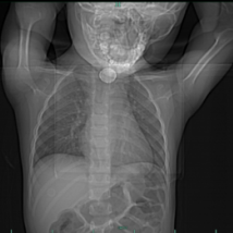 4 岁娃娃咽痛一周,竟藏着 「隐形杀手」!医生提醒:这类物品家家都有