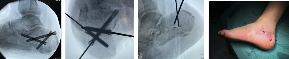 【融和有绝活】跟骨骨折不用「大动刀」,微创技术解您忧