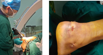 【融和有绝活】跟骨骨折不用「大动刀」,微创技术解您忧