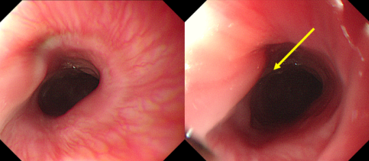 4 岁娃娃咽痛一周,竟藏着 「隐形杀手」!医生提醒:这类物品家家都有