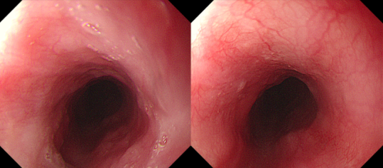 4 岁娃娃咽痛一周,竟藏着 「隐形杀手」!医生提醒:这类物品家家都有