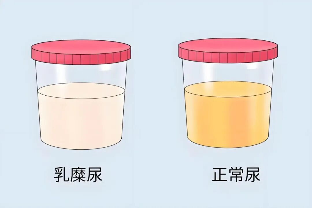 75 岁奶奶尿液像牛奶一样白？不疼不痒却藏大问题