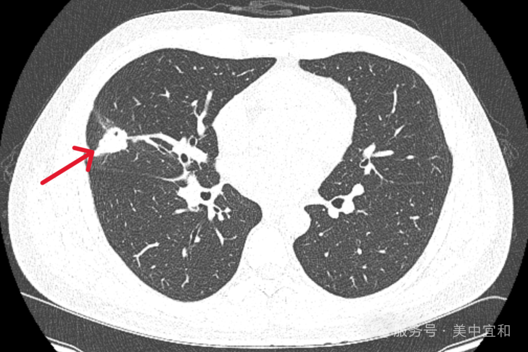 一句额外的医嘱，「揪出」早期肺癌风险