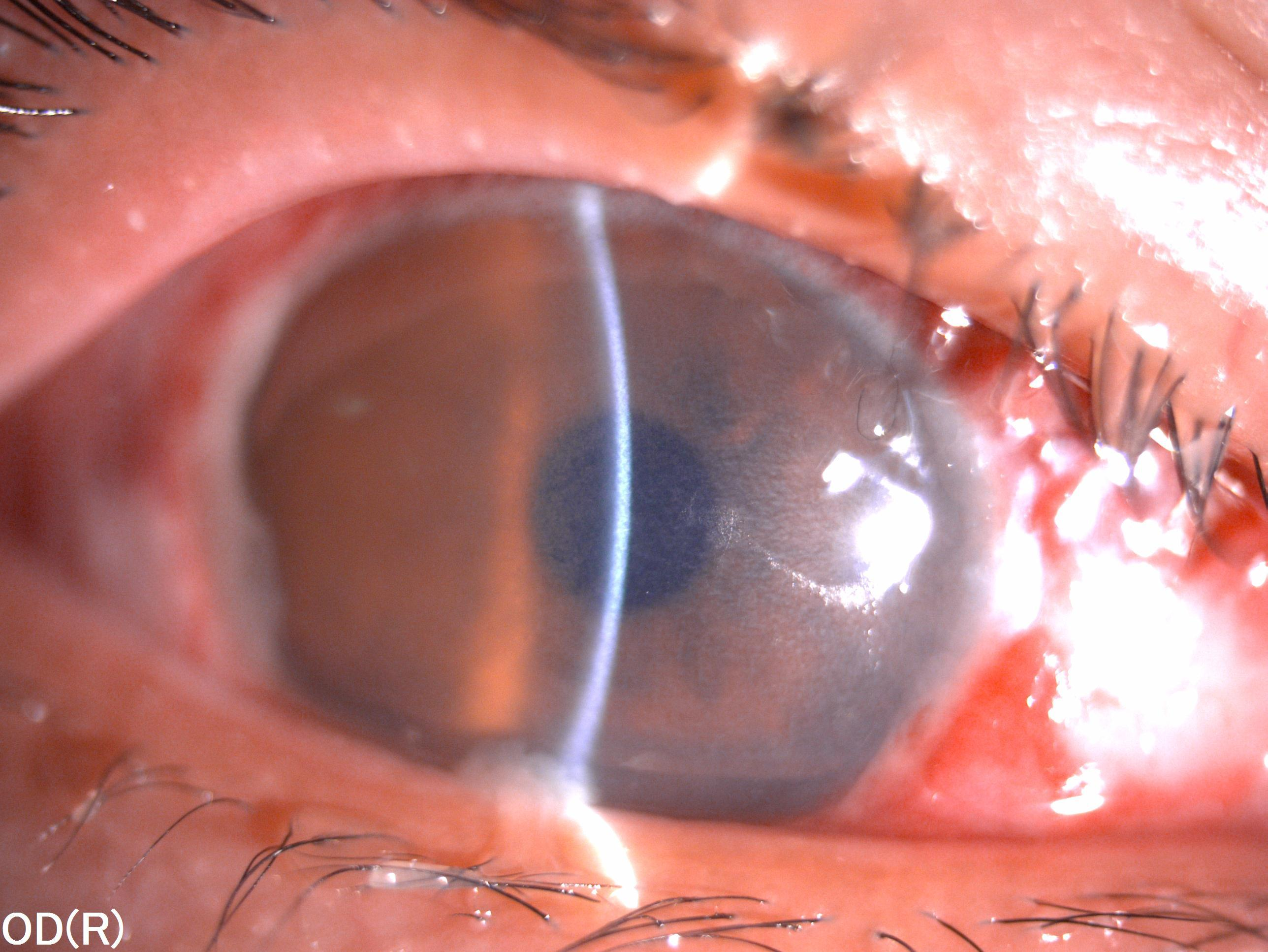 00 后小伙眼溅水泥砂浆被灼伤  武汉普瑞眼科专家紧急手术守护光明