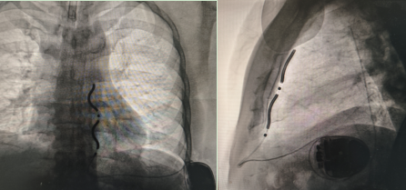 南昌大学二附院心血管内科成功为一心脏骤停患者植入省内首例血管外心律转复除颤器