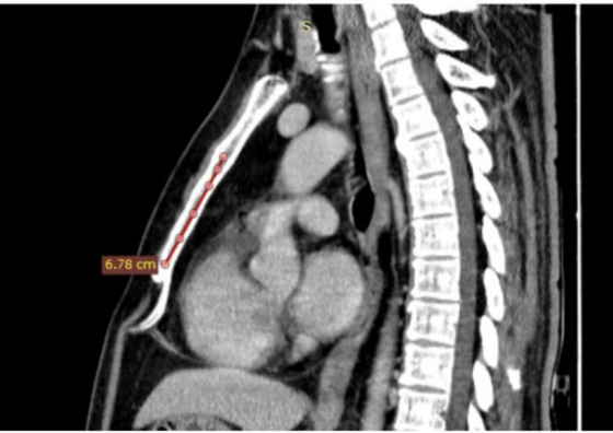 南昌大学二附院心血管内科成功为一心脏骤停患者植入省内首例血管外心律转复除颤器