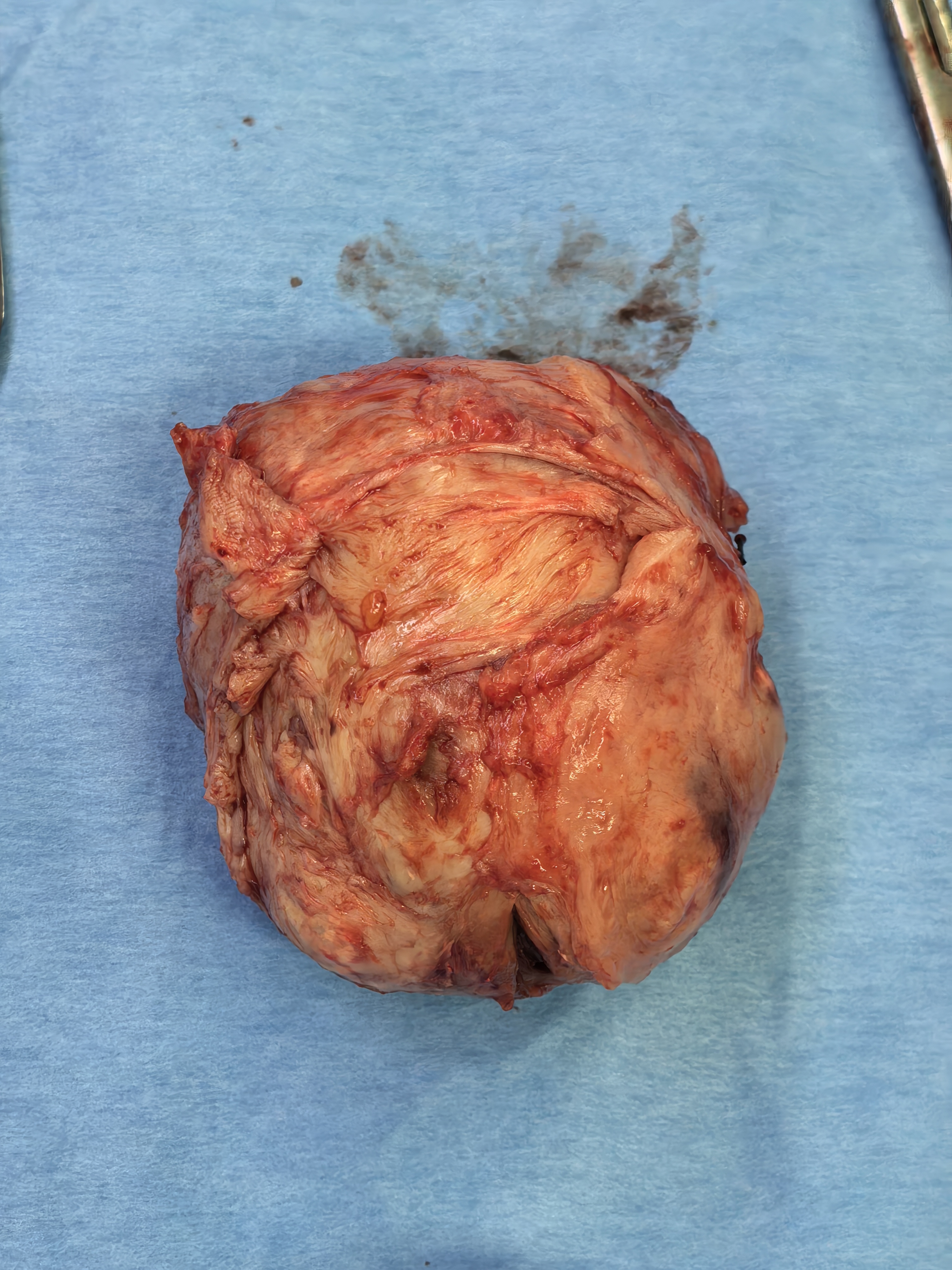 多学科团队协力攻坚，复杂高危孕妈平安完成剖宫产并成功剔除巨大肌瘤