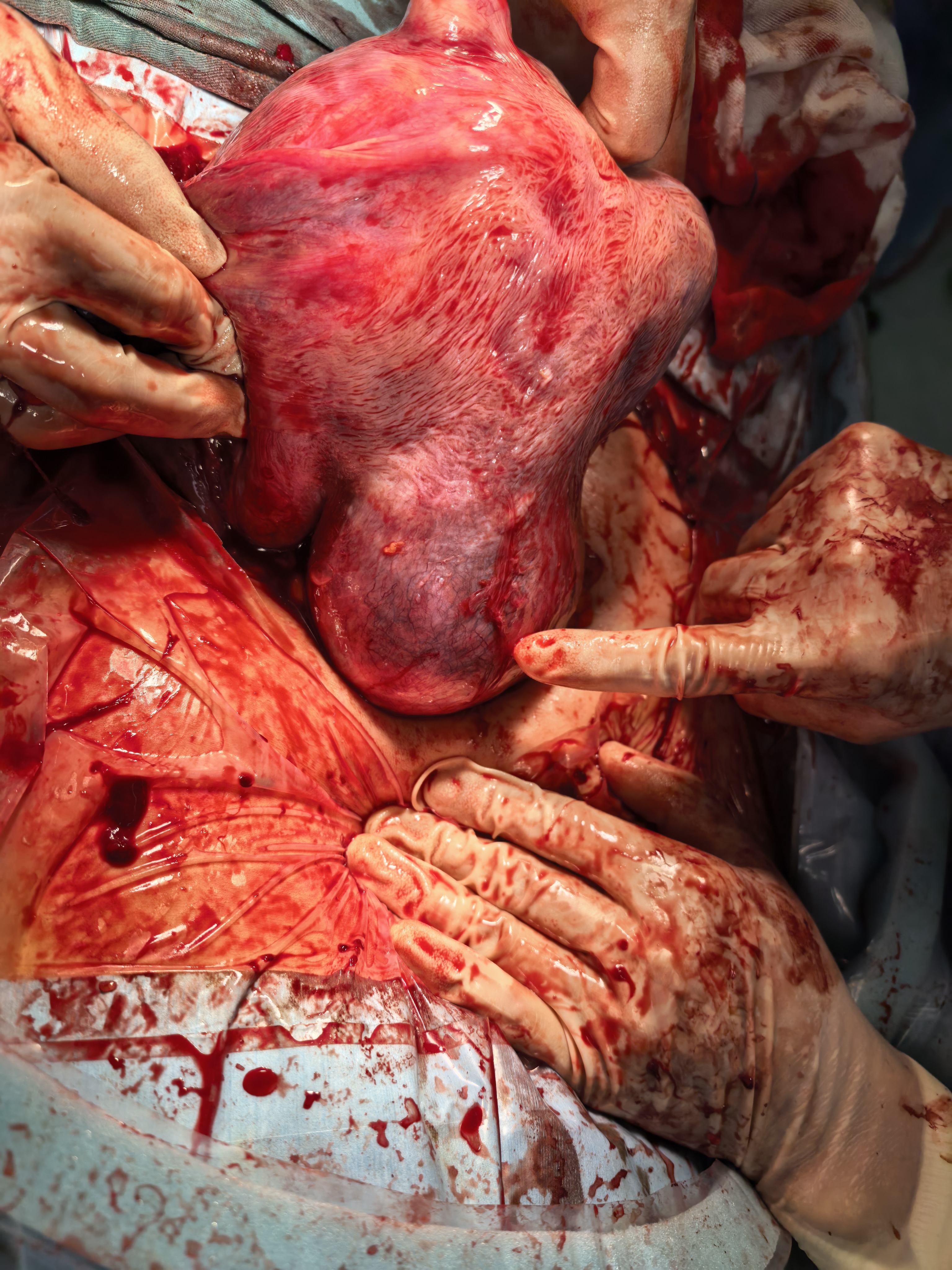 多学科团队协力攻坚，复杂高危孕妈平安完成剖宫产并成功剔除巨大肌瘤