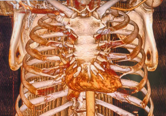南昌大学二附院心血管内科成功为一心脏骤停患者植入省内首例血管外心律转复除颤器