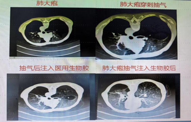 常州二院成功实施 CT 引导下肺大疱减容术