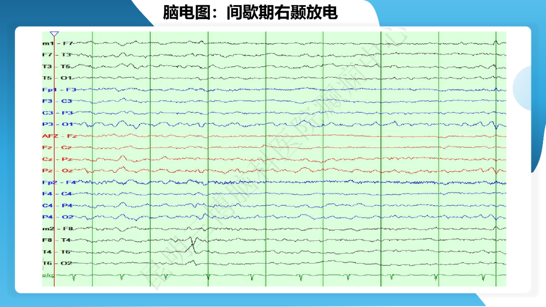 《「痫停」信步》癫痫治疗病例荟萃第三十二期---手术治疗伴海马硬化的颞叶内侧型癫痫一例