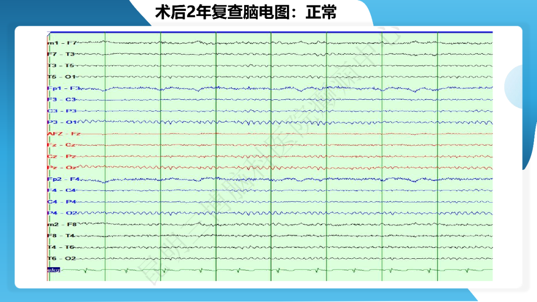 《「痫停」信步》癫痫治疗病例荟萃第三十二期---手术治疗伴海马硬化的颞叶内侧型癫痫一例