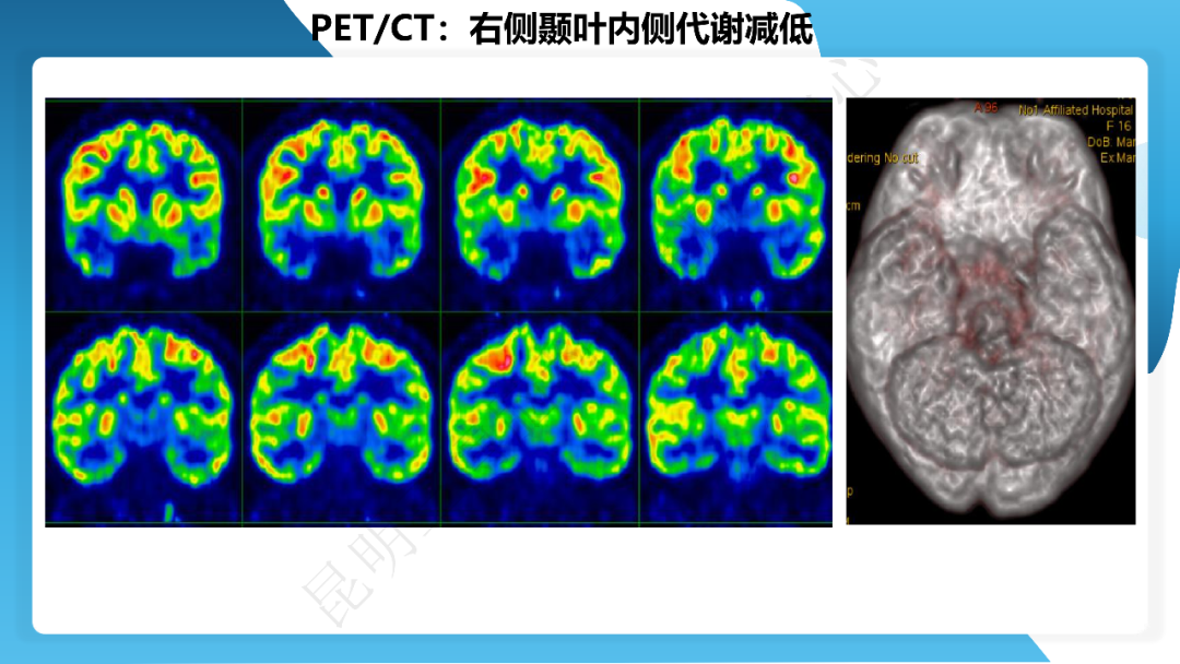 《「痫停」信步》癫痫治疗病例荟萃第三十二期---手术治疗伴海马硬化的颞叶内侧型癫痫一例