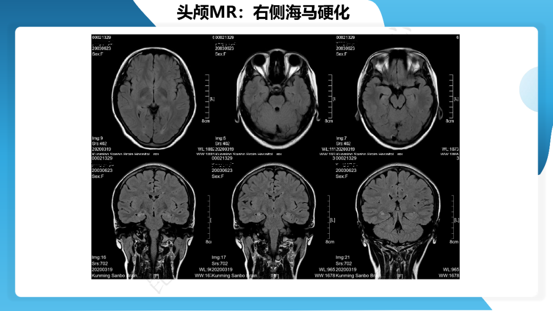 《「痫停」信步》癫痫治疗病例荟萃第三十二期---手术治疗伴海马硬化的颞叶内侧型癫痫一例