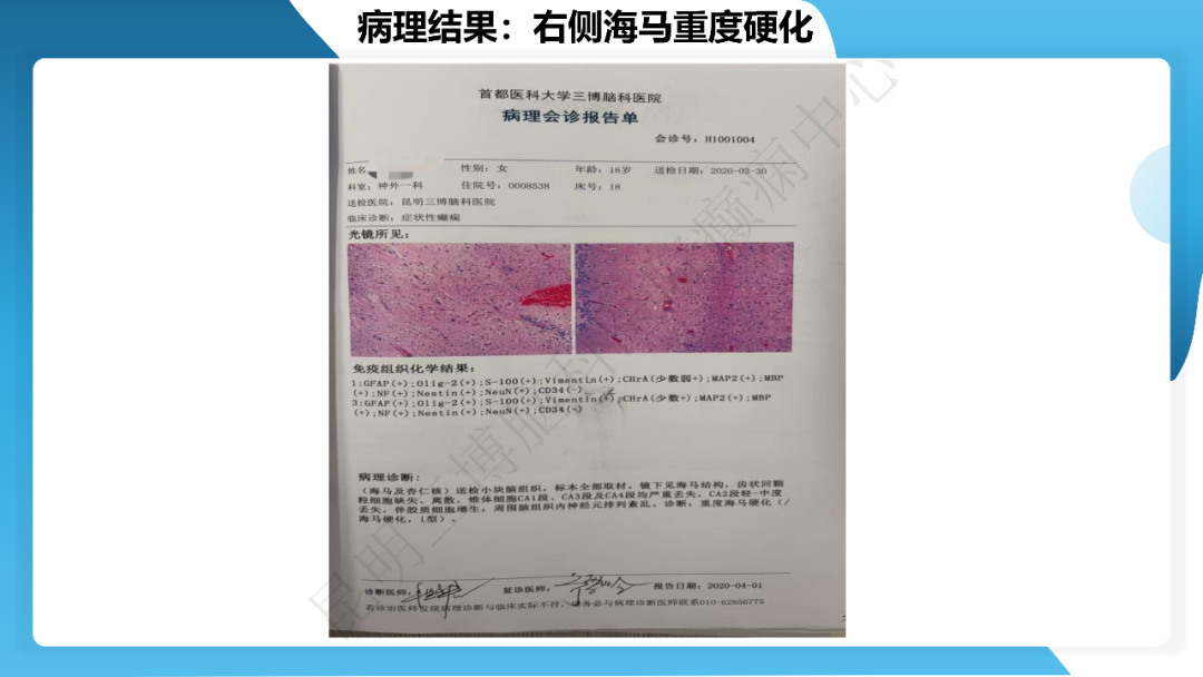 《「痫停」信步》癫痫治疗病例荟萃第三十二期---手术治疗伴海马硬化的颞叶内侧型癫痫一例