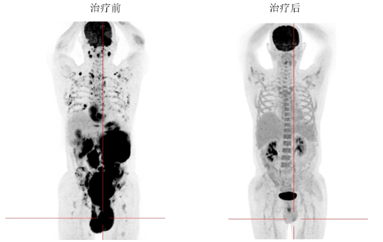 和祐首例|自体移植成功控制老年晚期淋巴瘤