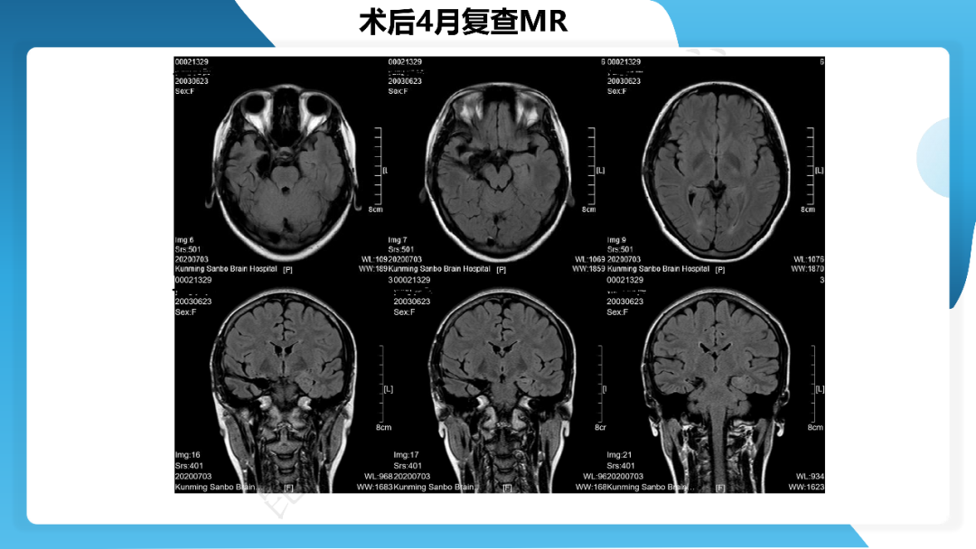 《「痫停」信步》癫痫治疗病例荟萃第三十二期---手术治疗伴海马硬化的颞叶内侧型癫痫一例