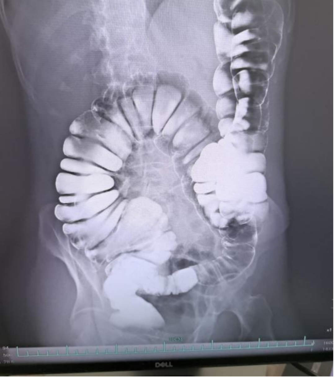 一个星期没排便,「便便」都去哪了?