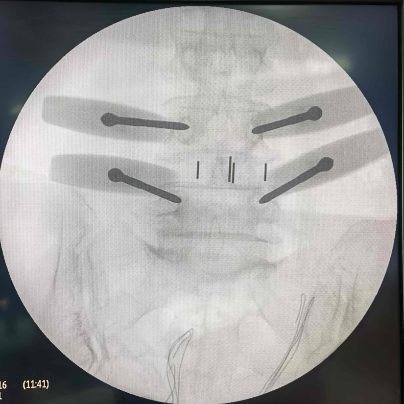哥伦比亚专家跨越重洋来 「取经」!浙大四院这项微创技术,要火到南美了