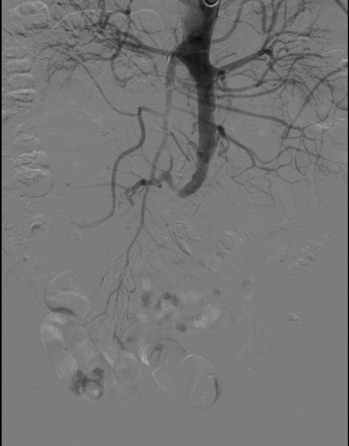 他险些失去双腿，竟因误判「病根」！