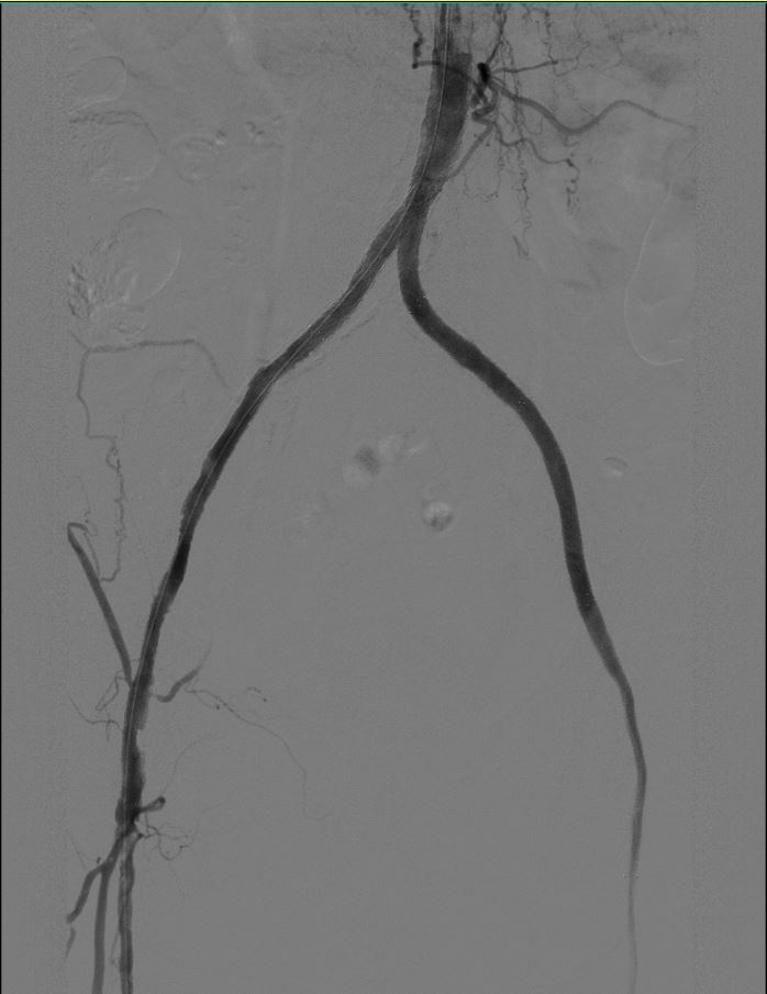 他险些失去双腿，竟因误判「病根」！