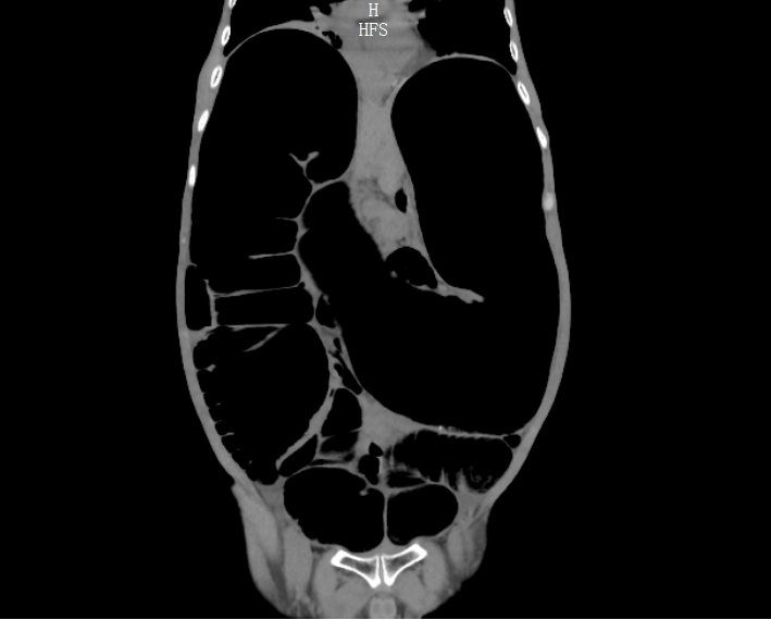 多年「拉不出」,元凶竟是成人罕见「巨结肠」!勿把长期顽固性便秘当小事!