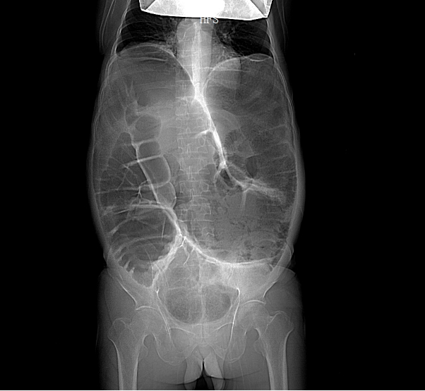 多年「拉不出」,元凶竟是成人罕见「巨结肠」!勿把长期顽固性便秘当小事!