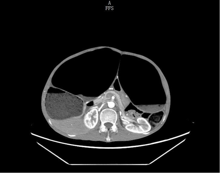 多年「拉不出」,元凶竟是成人罕见「巨结肠」!勿把长期顽固性便秘当小事!