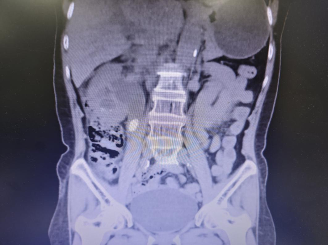 突发高烧,竟是泌尿结石引爆「脓毒血症」!身体报警别当「小感冒」,小心「隐形杀手」